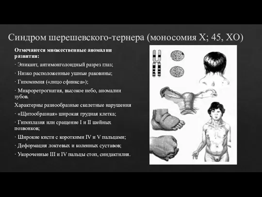 Синдром шерешевского-тернера (моносомия Х; 45, XО) Отмечаются множественные аномалии развития: · Эпикант,