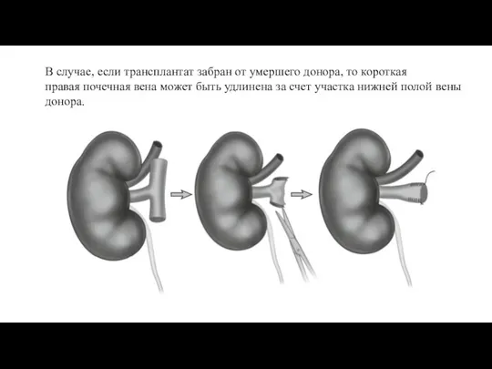 В случае, если трансплантат забран от умершего донора, то короткая правая почечная