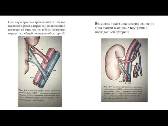 Почечную артерию трансплантата обычно анастомозируют с наружной подвздошной артерией по типу «конец