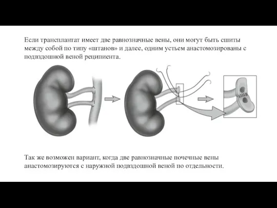 Если трансплантат имеет две равнозначные вены, они могут быть сшиты между собой