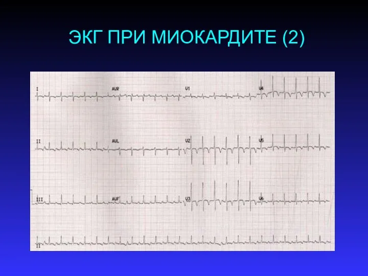 ЭКГ ПРИ МИОКАРДИТЕ (2)