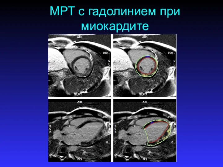МРТ с гадолинием при миокардите