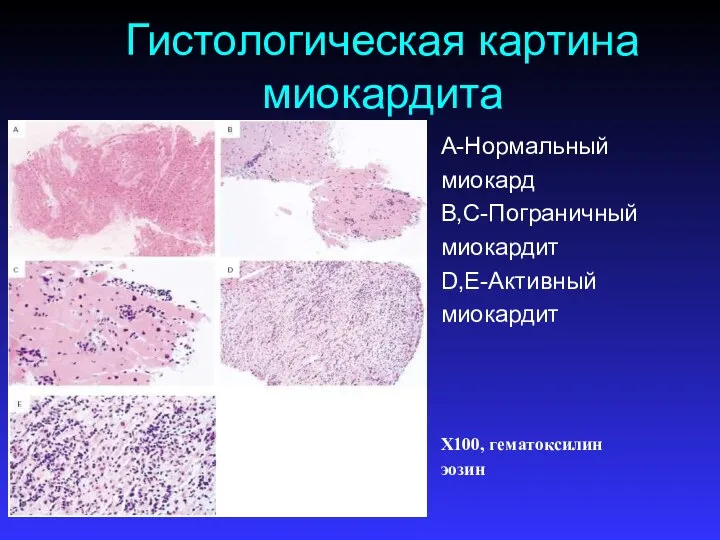 Гистологическая картина миокардита A-Нормальный миокард B,C-Пограничный миокардит D,E-Активный миокардит Х100, гематоксилин эозин