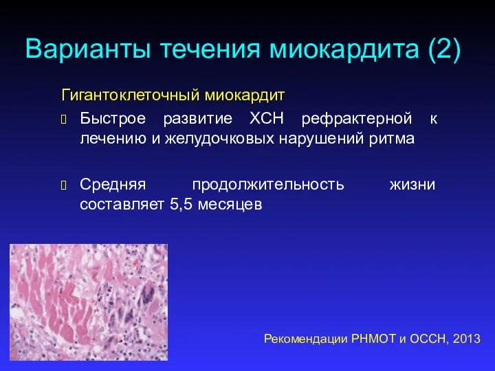 Варианты течения миокардита (2) Гигантоклеточный миокардит Быстрое развитие ХСН рефрактерной к лечению