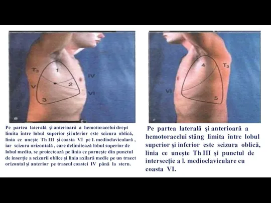 Pe partea laterală şi anterioară a hemotoracelui stâng limita între lobul superior