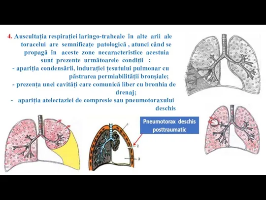 4. Auscultația respirației laringo-traheale în alte arii ale toracelui are semnificațe patologică