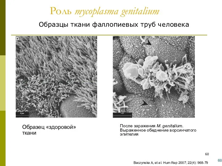 Роль mycoplasma genitalium Образцы ткани фаллопиевых труб человека 1Baczynska A, et al.