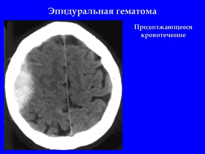 Эпидуральная гематома Продолжающееся кровотечение