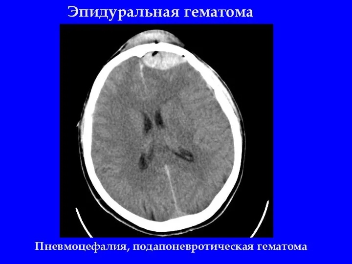 Эпидуральная гематома Пневмоцефалия, подапоневротическая гематома