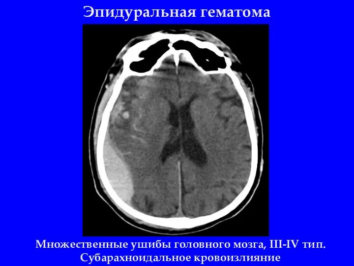 Эпидуральная гематома Множественные ушибы головного мозга, III-IV тип. Субарахноидальное кровоизлияние