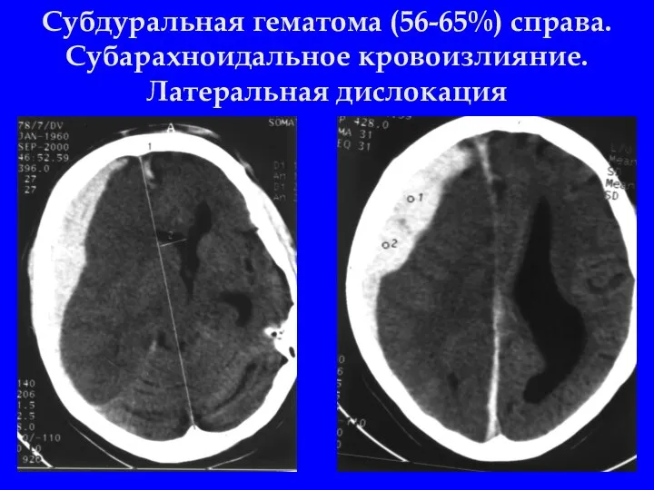 Субдуральная гематома (56-65%) справа. Субарахноидальное кровоизлияние. Латеральная дислокация