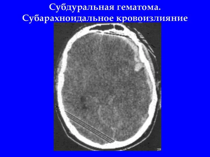 Субдуральная гематома. Субарахноидальное кровоизлияние