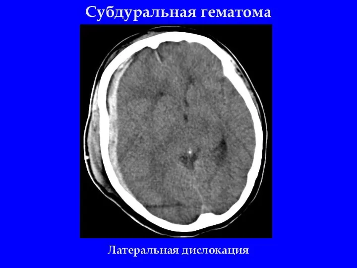 Субдуральная гематома Латеральная дислокация