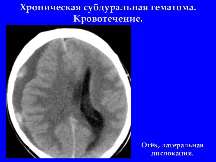 Хроническая субдуральная гематома. Кровотечение. Отёк, латеральная дислокация.