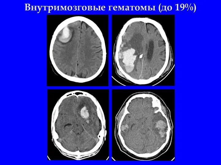 Внутримозговые гематомы (до 19%)