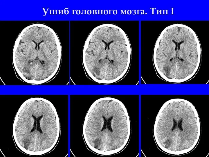 Ушиб головного мозга. Тип I