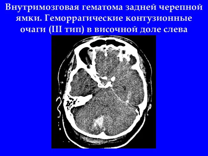 Внутримозговая гематома задней черепной ямки. Геморрагические контузионные очаги (III тип) в височной доле слева