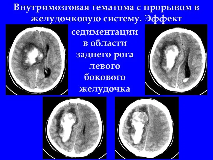 Внутримозговая гематома с прорывом в желудочковую систему. Эффект седиментации в области заднего рога левого бокового желудочка