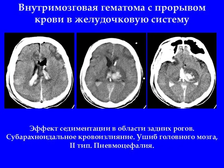 Внутримозговая гематома с прорывом крови в желудочковую систему Эффект седиментации в области