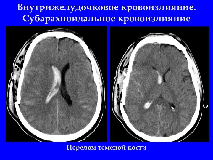 Внутрижелудочковое кровоизлияние. Субарахноидальное кровоизлияние Перелом теменой кости