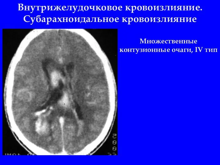 Внутрижелудочковое кровоизлияние. Субарахноидальное кровоизлияние Множественные контузионные очаги, IV тип