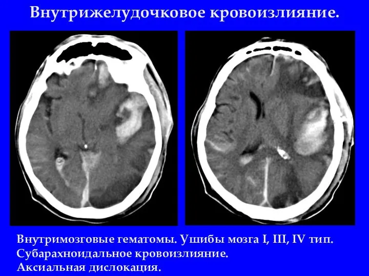 Внутрижелудочковое кровоизлияние. Внутримозговые гематомы. Ушибы мозга I, III, IV тип. Субарахноидальное кровоизлияние. Аксиальная дислокация.