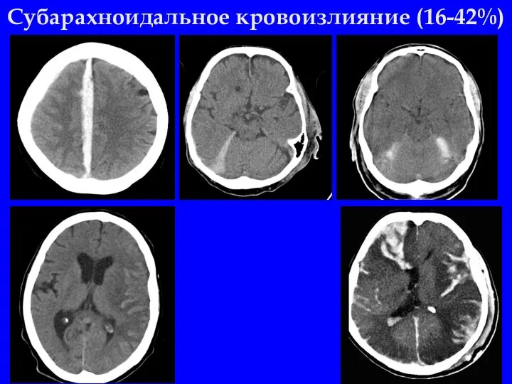 Субарахноидальное кровоизлияние (16-42%)