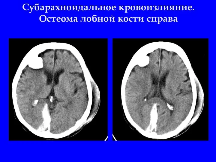 Субарахноидальное кровоизлияние. Остеома лобной кости справа