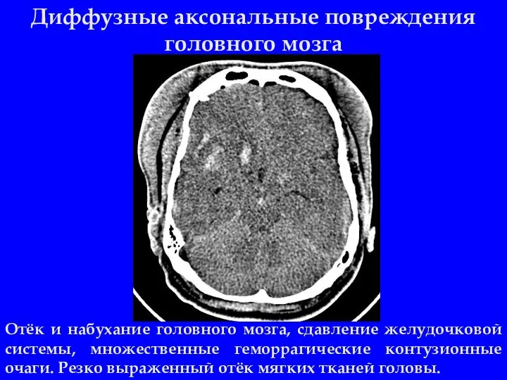 Диффузные аксональные повреждения головного мозга Отёк и набухание головного мозга, сдавление желудочковой