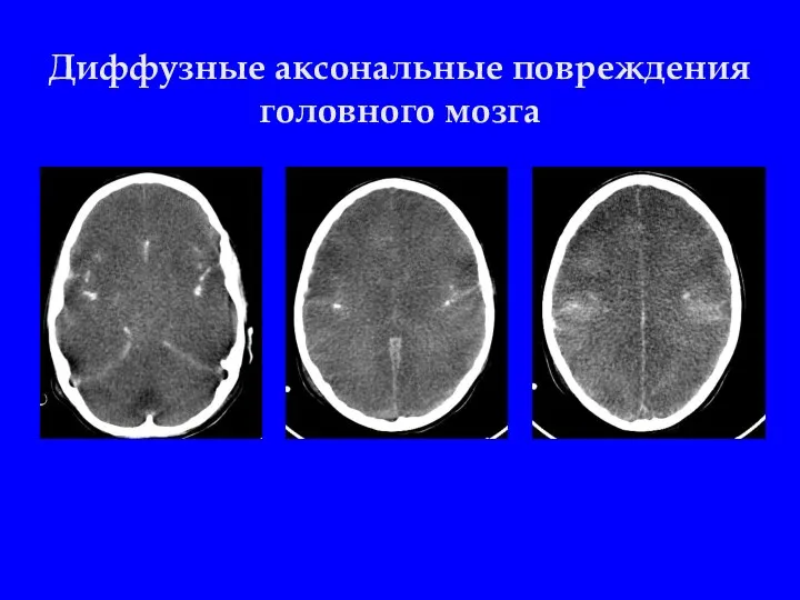 Диффузные аксональные повреждения головного мозга