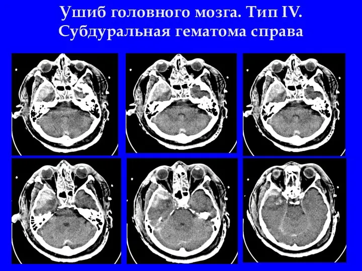 Ушиб головного мозга. Тип IV. Cубдуральная гематома справа