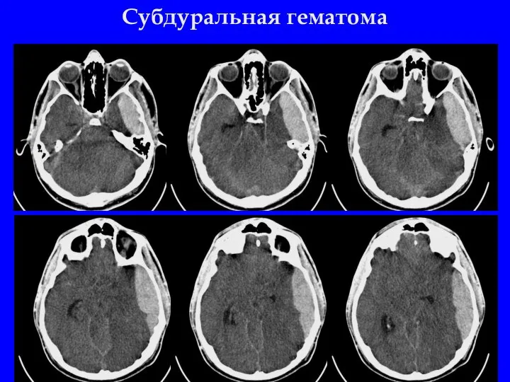 Субдуральная гематома