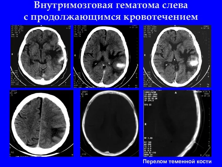 Внутримозговая гематома слева с продолжающимся кровотечением Перелом теменной кости