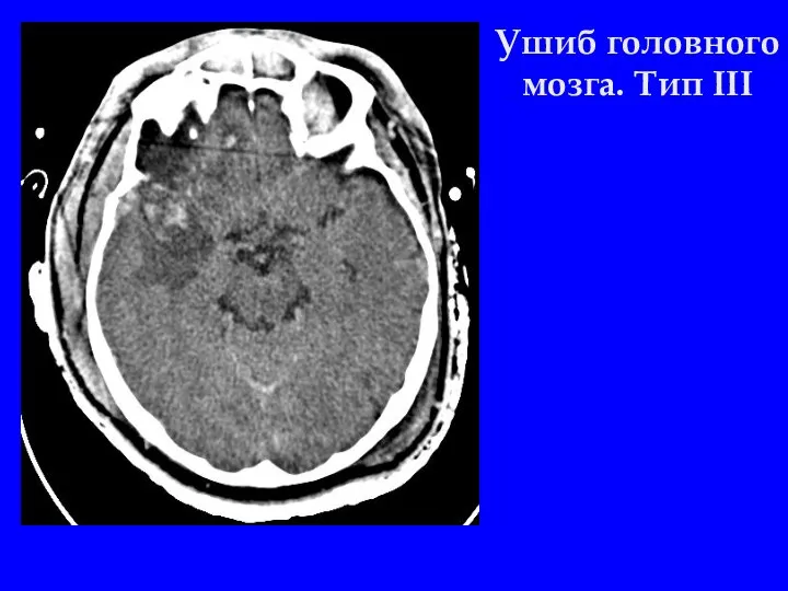 Ушиб головного мозга. Тип III