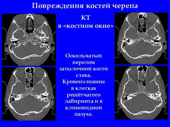 Повреждения костей черепа Оскольчатый перелом затылочной кости слева. Кровоизлияние в клетках решётчатого