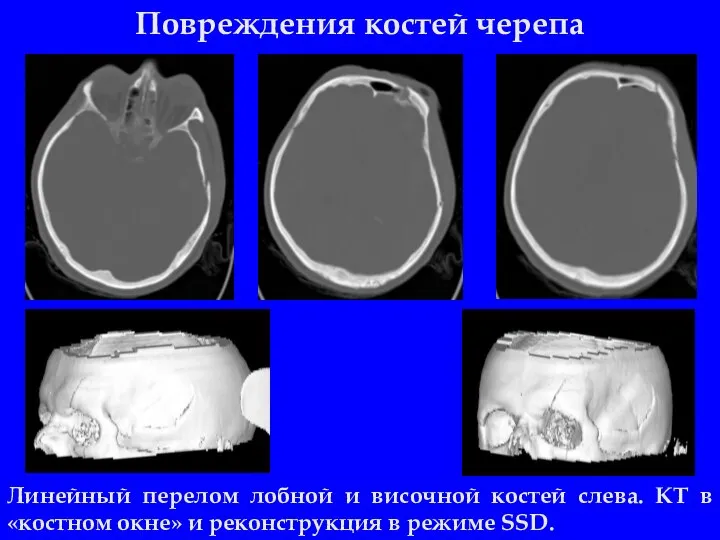 Повреждения костей черепа Линейный перелом лобной и височной костей слева. КТ в