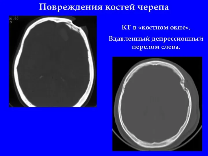 Повреждения костей черепа КТ в «костном окне». Вдавленный депрессионный перелом слева.