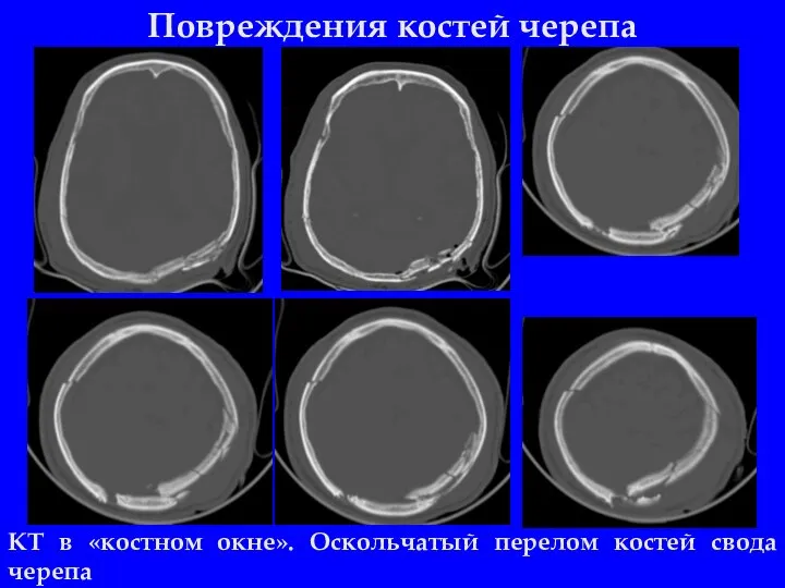 Повреждения костей черепа КТ в «костном окне». Оскольчатый перелом костей свода черепа