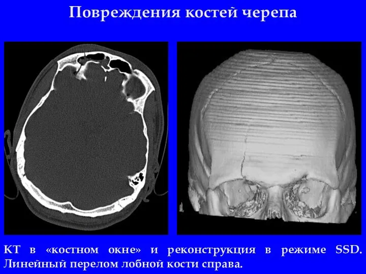 Повреждения костей черепа КТ в «костном окне» и реконструкция в режиме SSD.