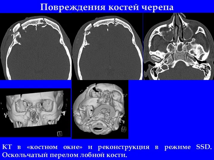 Повреждения костей черепа КТ в «костном окне» и реконструкция в режиме SSD. Оскольчатый перелом лобной кости.