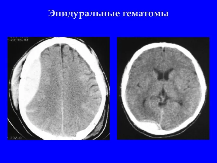 Эпидуральные гематомы