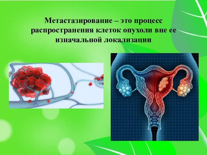 Метастазирование – это процесс распространения клеток опухоли вне ее изначальной локализации