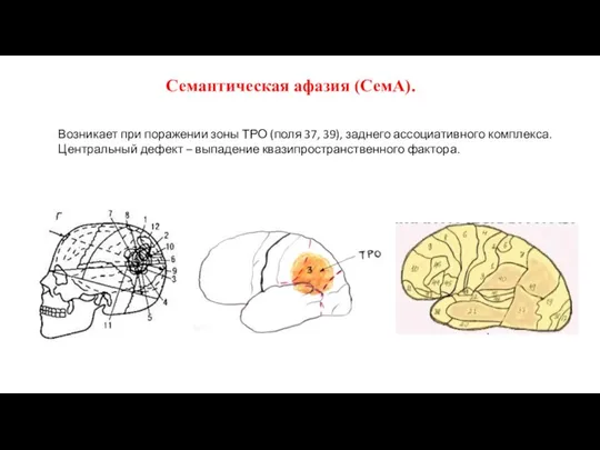 Семантическая афазия (СемА). Возникает при поражении зоны ТРО (поля 37, 39), заднего