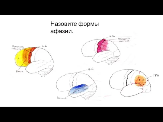 Назовите формы афазии.