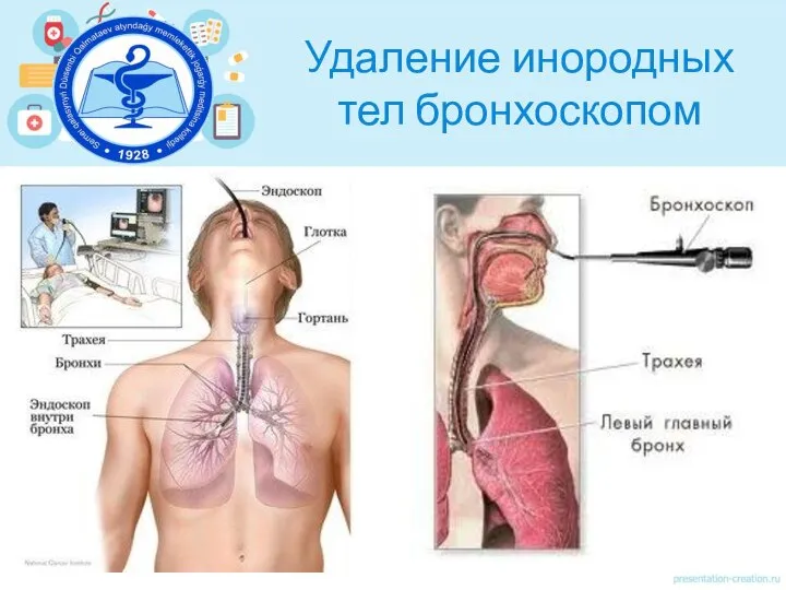 Удаление инородных тел бронхоскопом