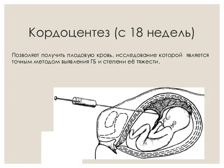 Кордоцентез (с 18 недель) Позволяет получить плодовую кровь, исследование которой является точным