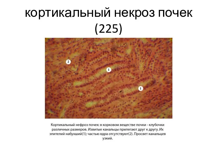 кортикальный некроз почек(225)