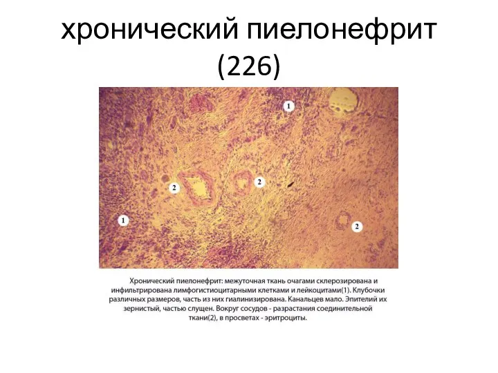 хронический пиелонефрит(226)