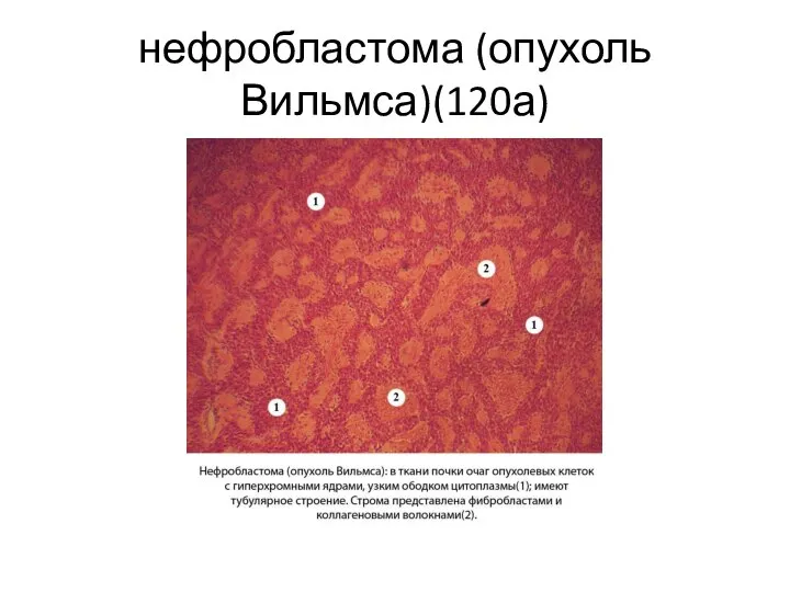 нефробластома (опухоль Вильмса)(120а)