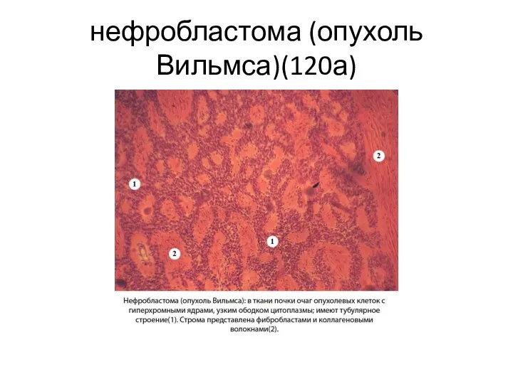 нефробластома (опухоль Вильмса)(120а)